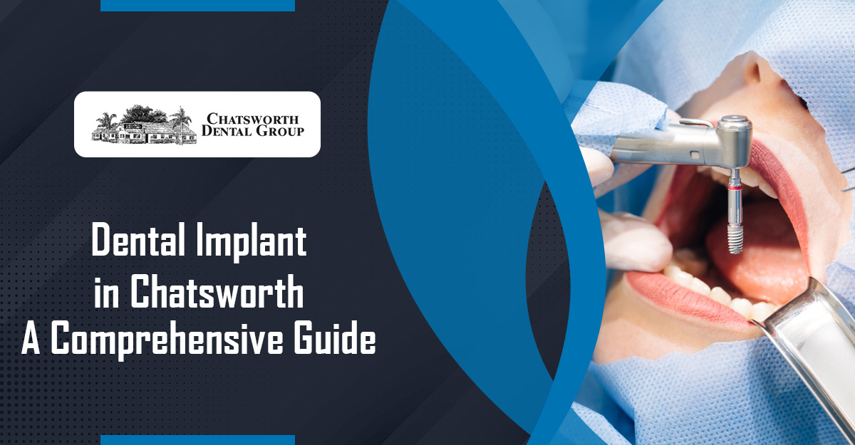 Dental Implant in Chatsworth